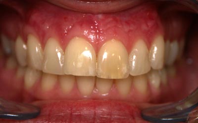 microchirurgie endodontique